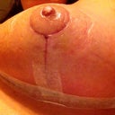20 days post op
