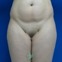 Liposculpture, Lipo Laser Or Laser Lipolysis