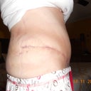 23 days post op