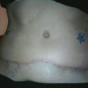 3.5 months post op