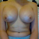 6 weeks post op