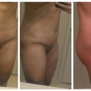 Day 5 Post Op. I feel SO much better with out that horrible drain! Swollen but feeling alright. Not really in any pain, just discomfort. I have been STARVING, but I guess that is due to all the healing going on! The incision is covered in steri-strip (or whatever it is called). I still have one stitch on each place the lipo tool went into my inner thighs. My inner thighs feel bruised today- I hadn't had any pain from them before now. They are still swollen.
