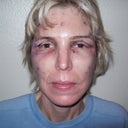 9 Hours After Surgery