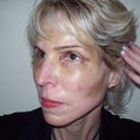 Healing - 3 Days After Surgery - no make-up
