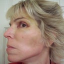 Healing 5 Days After Surgery - no make-up