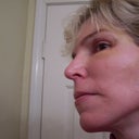 Healing 10 days After Surgery - no make-up