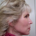 Still 10 days after surgery but I couldn't handle anymore pictures without make-up too scary. :-)