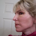 Still 10 days after surgery but with make-up