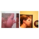 Left: Dr. Joseph took this photo September 20, 2012
Right: The day my cast was removed.  Only 1 week post operation!