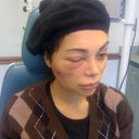 Me second time to reopen the abscess
