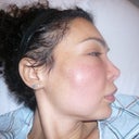 Me before surgery to open the abscess