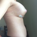 Post-op day 4 (right)... Bloat please go away!