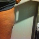 this bulge was not here before, is this just swelling? im 6-7 weeks post op. I have no lumps in my tummy or hips.