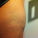 this bulge was not here before, is this just swelling? im 6-7 weeks post op. I have no lumps in my tummy or hips.