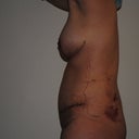 12 days post-op