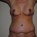 12 days post-op