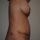 12 days post-op