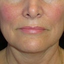 Before treatment