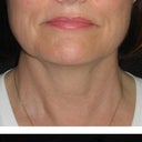 30 day post treatment