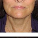 60 day post treatment