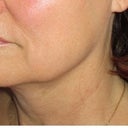Before treatment