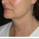 30 day post treatment