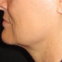 60 day post treatment