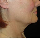 Before treatment