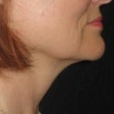 30 day post treatment