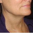 60 day pst treatment
