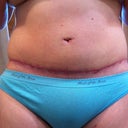 faded purple of scar using scaraway strips (pubis still swollen)