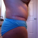 Side view of scar - almost 3 months post-op