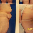 8 Weeks PO, Dr took these today Aug 14th,2012