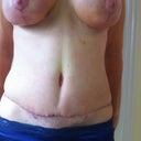 17 days out - scars looking better each day