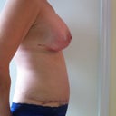 17 days out - Same underwear as my pre-op photos. Still a lot of swelling but my skin tone looks so much better.