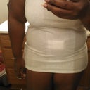 23 days post op