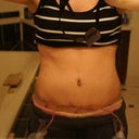 6 days post op