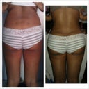 B4 pic & 1 month post op