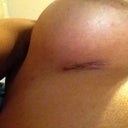 Right incision. Will use biocorneum tonight!