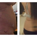 Before lipo, and then the first day after lipo