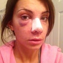 1 day post op. lots of swelling, but you can already tell it's much smaller and the tip is raised. :)