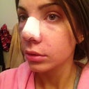 1 day post op.