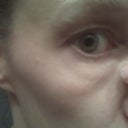 my puffy under eye 2 days after dysport