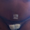3 days post-op