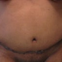 2 weeks post-op