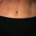One Year Post-op.. old stretch marks