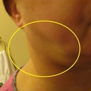 Rt side of chin fat was even removed in this picture