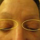 Eyelids on both eyes starting at tear ducts have maassice scars. Surgery was done over 2 yrs ago. (Permanent scars)