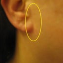 Ear sown to face with scars apparent all the way around. Everyone I see notices it. It is so obvious it makes me sick. Dr.s like this should lose their license.