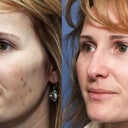 41 Year Old Female Treated For Photoaging With Pixel Laser